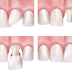 Ưu điểm của răng sứ titan