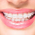 Có những loại niềng răng mắc cài nào?