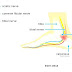 Tarsal tunnel syndrome