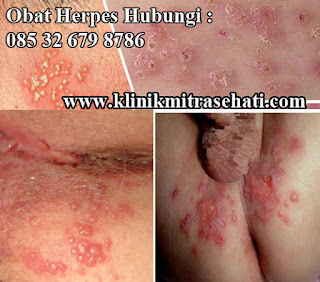 Pengobatan penyebab herpes kelamin dengan herbal