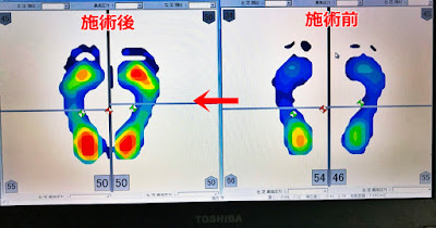 足圧バランス測定の施術前と施術後の比較①