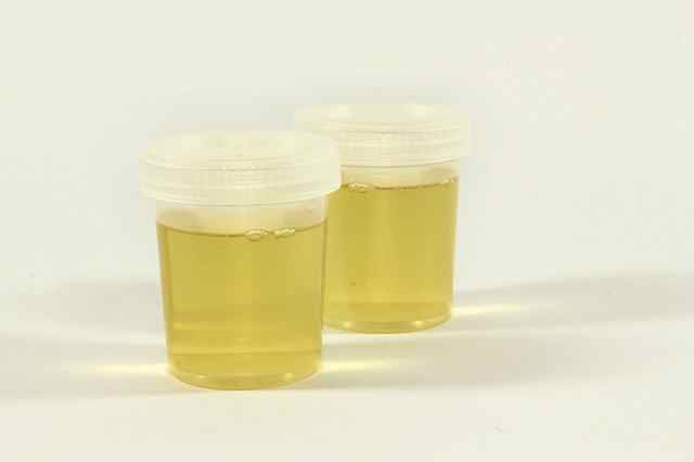 Why my urine Colour is white or yellow or red or green