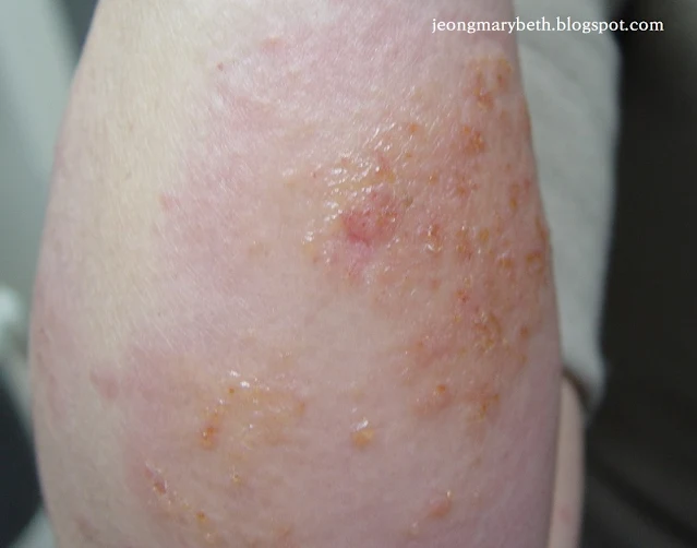 알레르기접촉피부염의 급성기 피부 병변 이미지