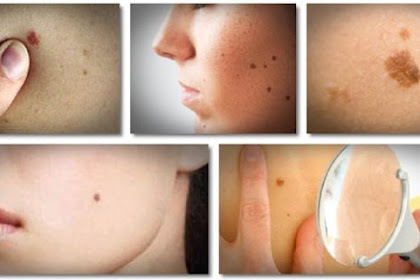 Natural Ways to Put an End to Moles, Warts, Blackheads, Skin Tags and Age Spots