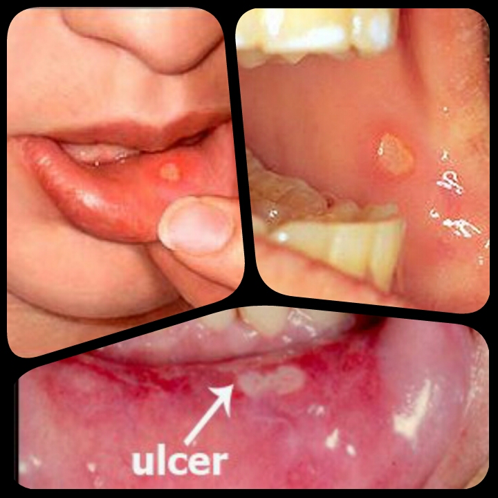 Merawat ulser mulut tanpa rasa pedih dan cegah berulang 