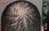 Why is the hair fall in men in the age of 20-30 years of age? 