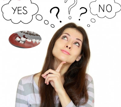 Có nên nhổ răng khôn hàm dưới không?