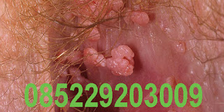 Obat Kutil Kelamin (Pria, Laki2, Wanita, Perempuan, Ibu hamil / menyusui / mengandung) - obat penghilang atau penghapus kutil kelamin tanpa operasi serta aman dan terbukti serta terpercaya