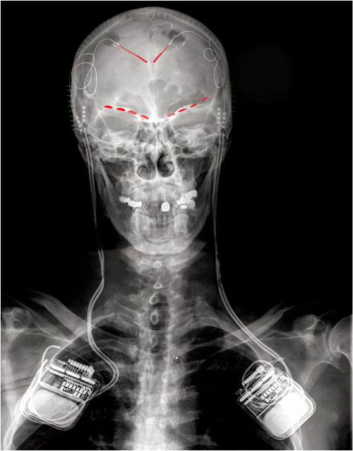 radiografía frontal que muestra la colocación de electrodos y dispositivos receptores en un participante del estudio