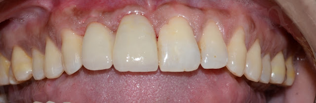 After Treatment of Save Broken Carious Teeth
