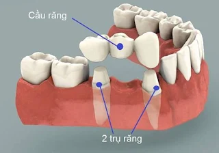 Quy trình làm cầu răng sứ -1