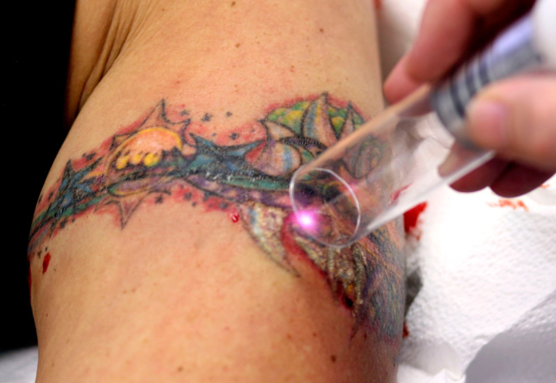 The Old Way of Tattoo Removal | LTR Corner