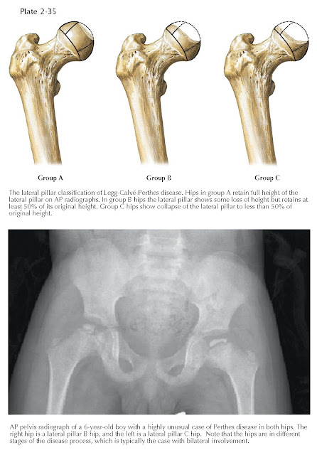 LEGG-CALVÉ-PERTHES DISEASE: LATERAL PILLAR CLASSIFICATION