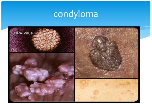Penyakit Condyloma
