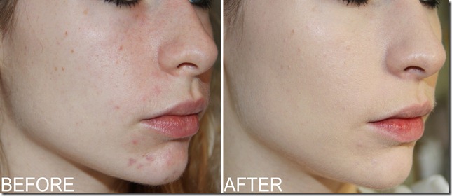 COVRFXBEFOREAFTER2