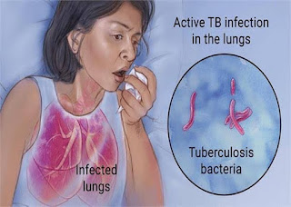 Tuberculosis causes symptoms, treatment