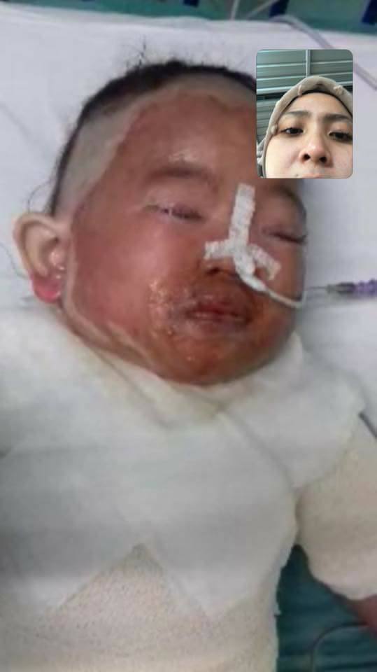 Anak melecur terkena air panas