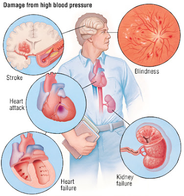 High Blood Pressure (Hypertension) 