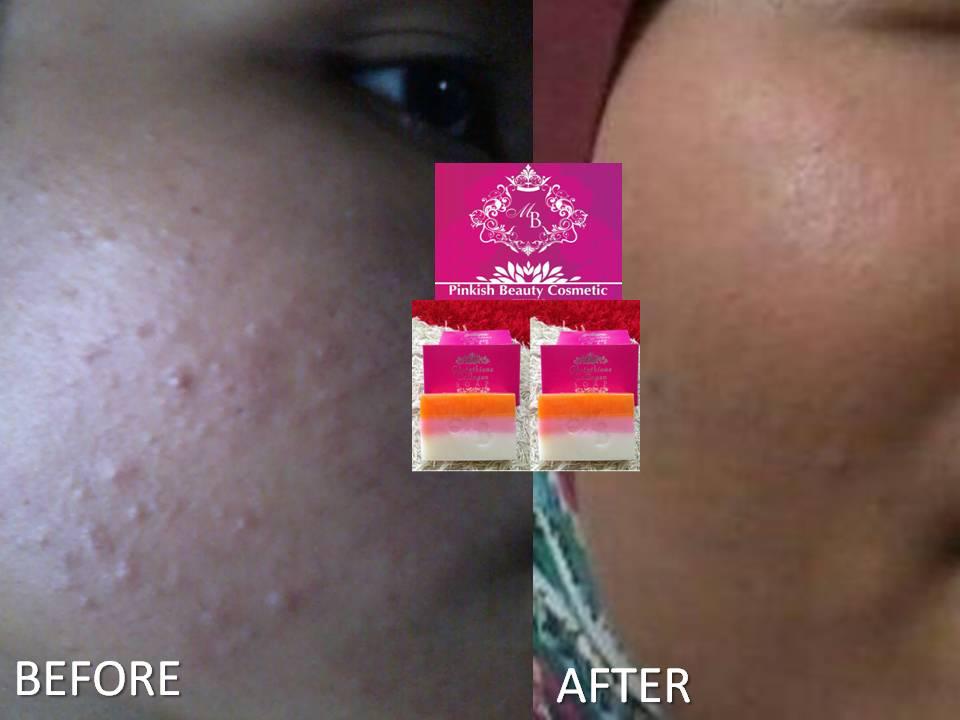 .: GLUTATHIONE COLLAGEN SOAP WITH KOJIC(HIGH RECOMMENDED)