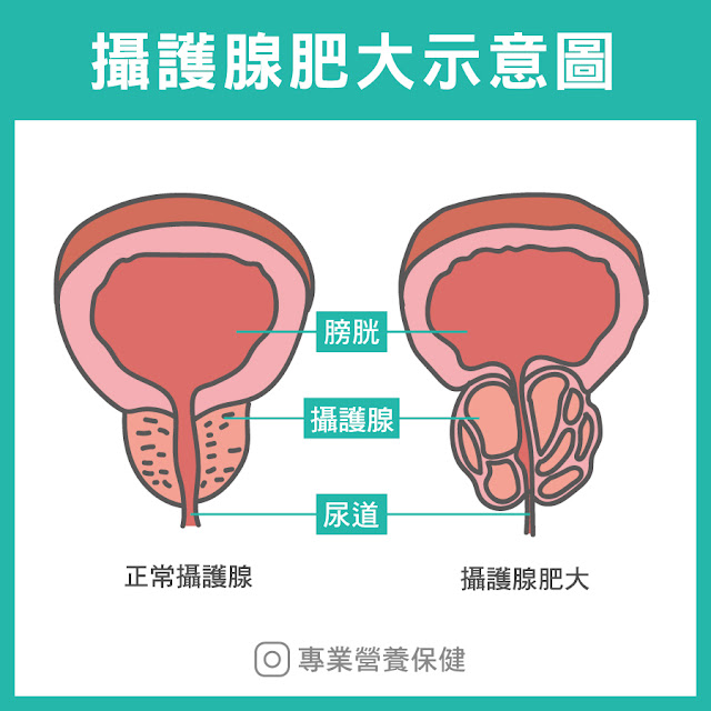 攝護腺肥大示意圖