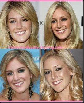 heidi montag nose job