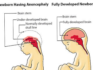 anencephaly