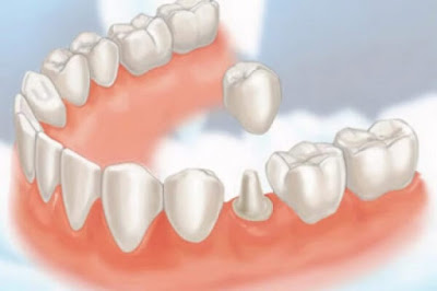 Bọc răng sứ giúp bạn cải thiện "nhan sắc" cho hàm răng
