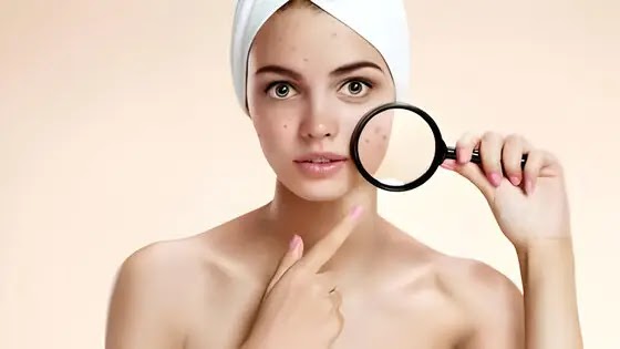 Fading the Past: Effective Strategies to Minimize Acne Scars