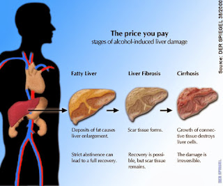  Tips Cara Mengobati Penyakit Liver Secara Alami Dan Tradisional