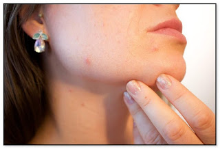 Discover 9 Ugly Lies About Acne Causes and Treatments