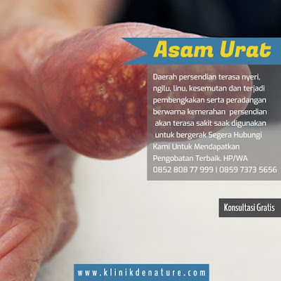 OBAT ASAM URAT DAN KOLESTEROL DI APOTIK