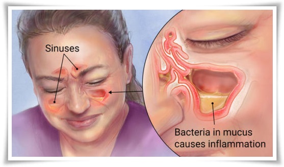 Cara Mengobati Sinusitis Secara Alami