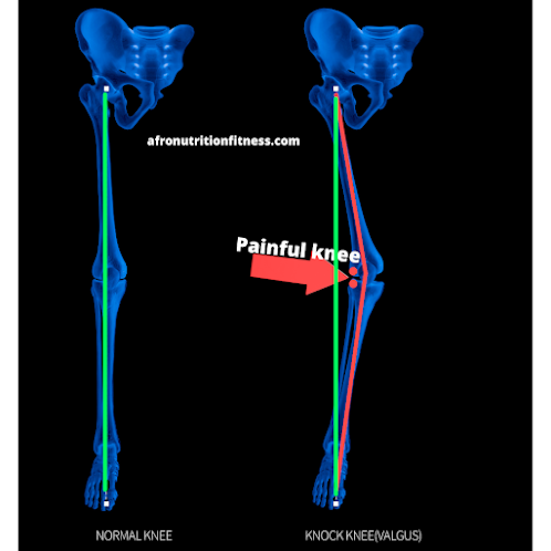 knee valgus