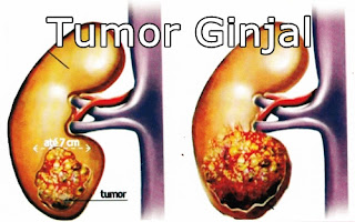 Obat Tumor Ginjal Tradisional