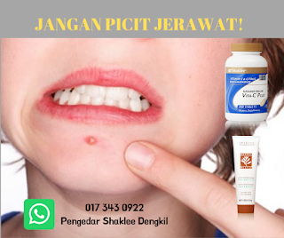 Vitamin Kecutkan Jerawat