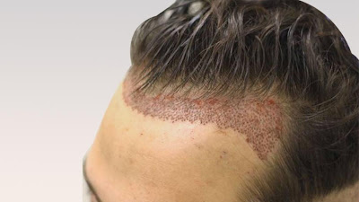 FUE Hair Transplant