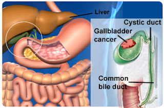 Types Of Most Common Cancer,Early Skin Cancer,Primary Liver Cancer,Most Common Cancer Types