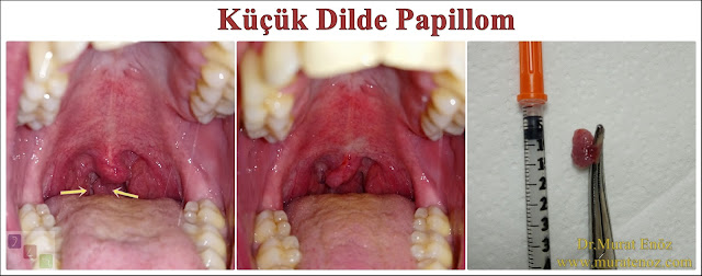 Küçük dilde papillom - Küçük dilde papillom belirtileri - Küçük dilde papillom  nasıl anlaşılır? - Uvulada papillom - Küçük dilde siğil - tedavisi - Küçük dilden papillom rezeksiyonu - Küçük dilde papillom tedavisi - Küçük dilde papillom ameliyatı - Ağızda papillom siğil - Ağızda HPV enfeksiyonu - İnsan papilloma virüsü - HPV virüsü - Ağızda HPV enfeksiyonu