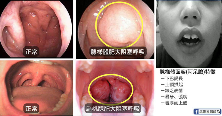 小朋友打鼾恐阻礙學習與生長發育 扁桃腺與腺樣體肥大 照護線上