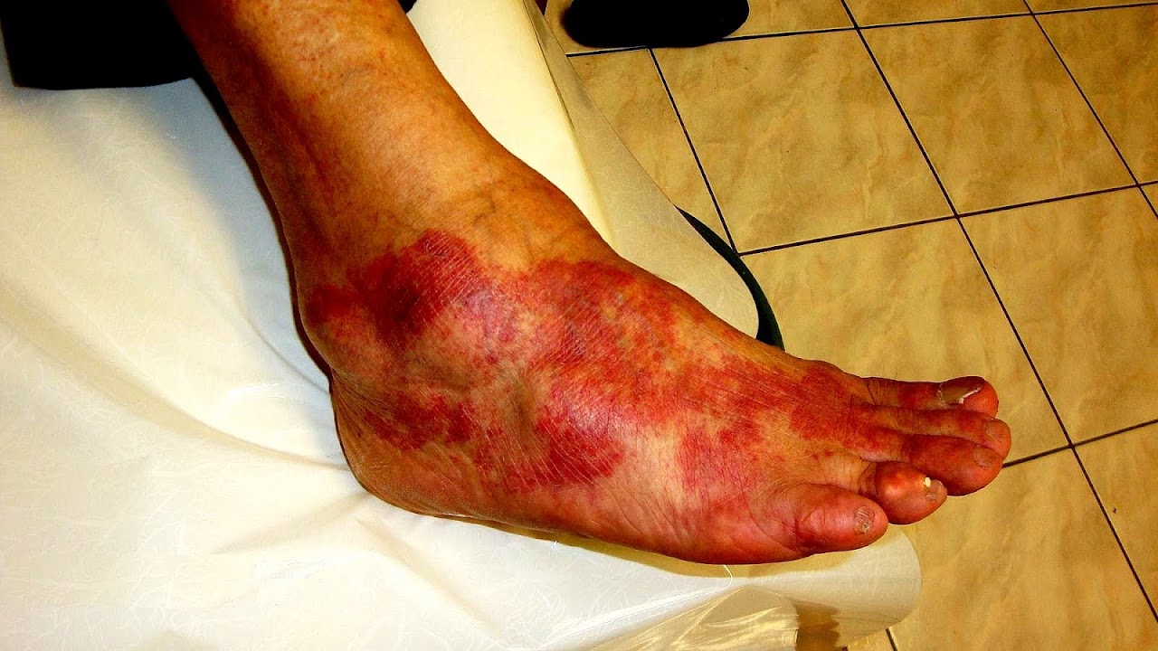 Hydrocodone/paracetamol - Acetaminophen Allergy