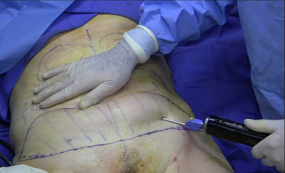 liposuction undergoing in operation theatre