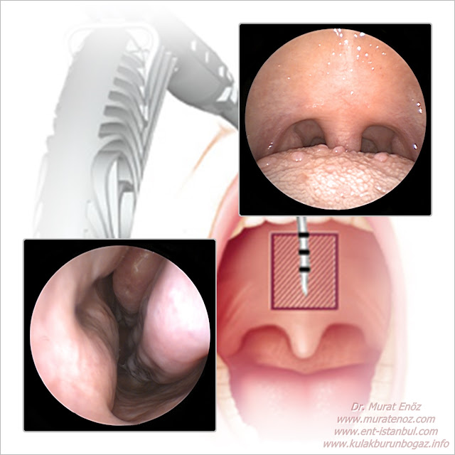 Pillar Implant Horlama Tedavisi - Damak İmplantı