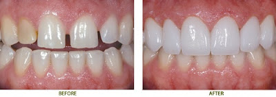  Đối tượng nên trám răng    Trám răng là kỹ thuật khắc phục được khá nhiều khuyết điểm nhưng không phải khuyết điểm nào cũng cho kết quả an toàn. Bạn có thể trám răng khi là một trong những đối tượng sau đây:    - Khách hàng bị sâu răng, mòn cổ răng, viêm tủy do thức ăn tồn đọng ở vùng chân răng lâu ngày làm vi khuẩn phát triển và ăn sâu vào lỗ chân răng gây nên.    - Khách hàng bị mất một phàn răng, bị mẻ răng do va chạm mạnh hoặc tai nạn. Do đó trám răng nhằm khắc phục khuyết điểm và giúp việc ăn nhai dễ dàng hơn.     - Cải thiện tính thẩm mỹ cho hàm răng, thay lại mảng trám răng đã thực hiện trước đây để duy trì sự chắc khỏe của hàm răng. 