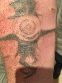 Tattoo shortly after picosure laser session showing swelling