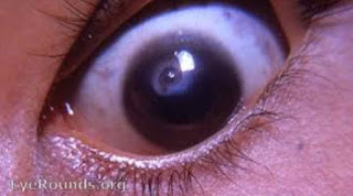 Short cases in ophthalmology
