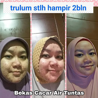 bekas cacar hilang/ testemoni