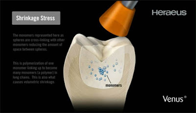 implant-dentist-sydney-combatting-air-bubbles-in-dental-ceramics