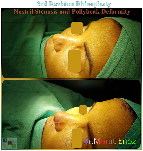 3rd Revision Rhinoplasty - Nostril Stenosis and Pollybeak Deformity - Complication Nose Surgery