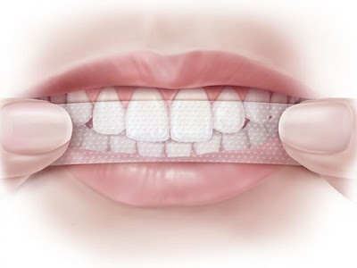 Miếng dán làm trắng răng crest có an toàn hay không?