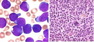 Neoplastic proliferations of white blood cells - Acute Leukemias (AL)